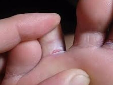 Got toe fungus