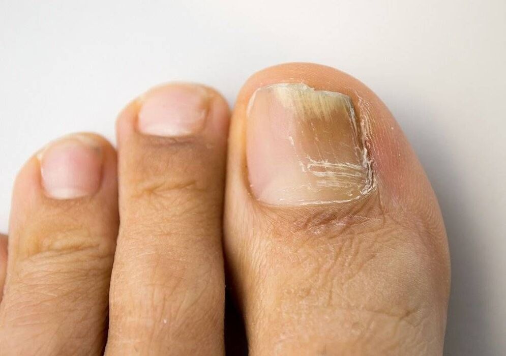 type of fungal infection on the big toe