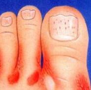 Fungus on the feet