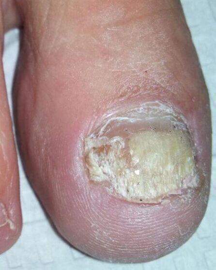 Fungus on the feet