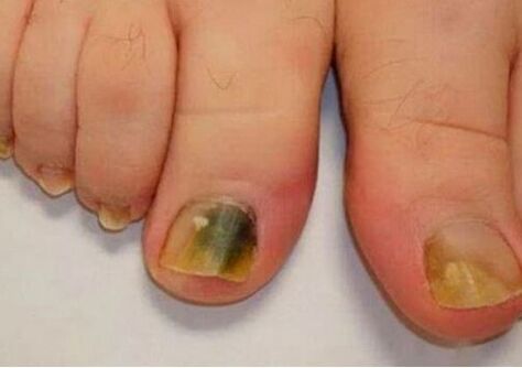 Infection affects the nail plate