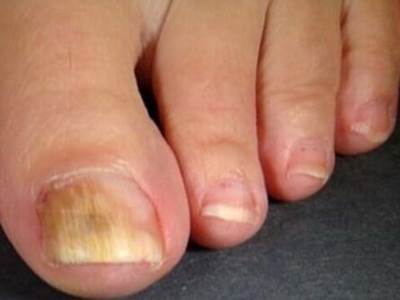 Nail fungus