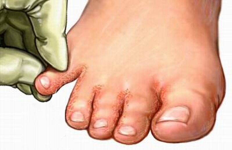 Fungus on the feet