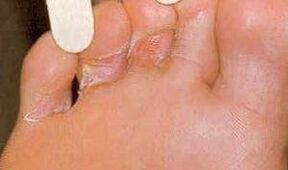Donation wounds for foot mycosis