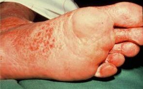 Fungus on the feet with ulcers