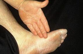 The removed form of mycosis is indicated by peeling