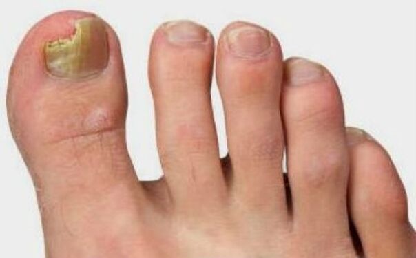Fungus on the thumbs