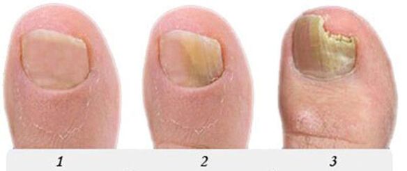 The process of developing fungus in the thumb