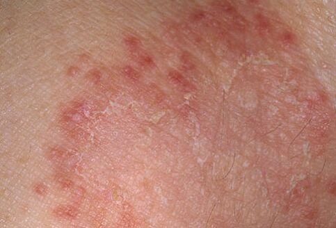 A quick way of cure fungus, doctors will tell