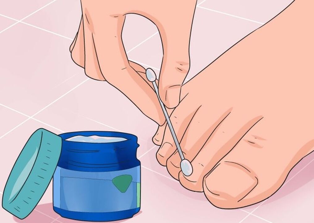 cure nail fungus