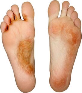 cure the fungus in the finger and not take it anymore