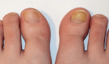 The early stages of nail fungus