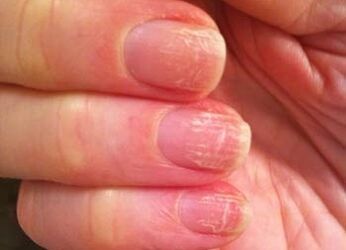 The early stages of the fungus on the nails