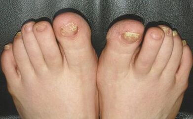 Signs -to fungus on nails