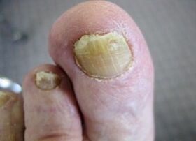 The cause of the appearance of fungus on the nails