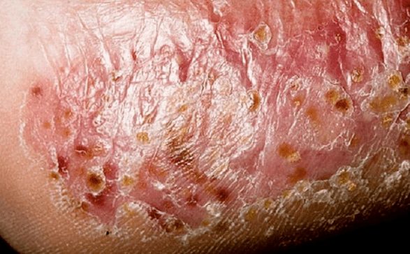 Fungus