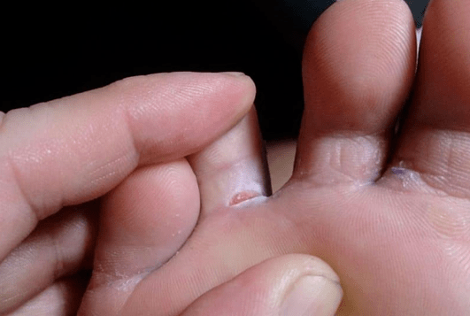 The appearance of bubble formation in the foot