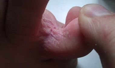 Stage of fungal development between the toes