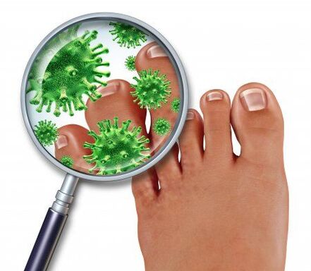 Fungal infection on the feet