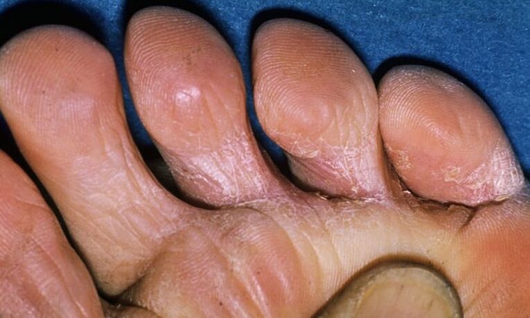 Different types of foot fungus