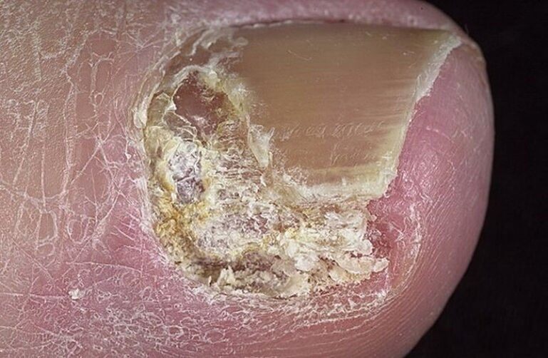 The type of onychomycosis