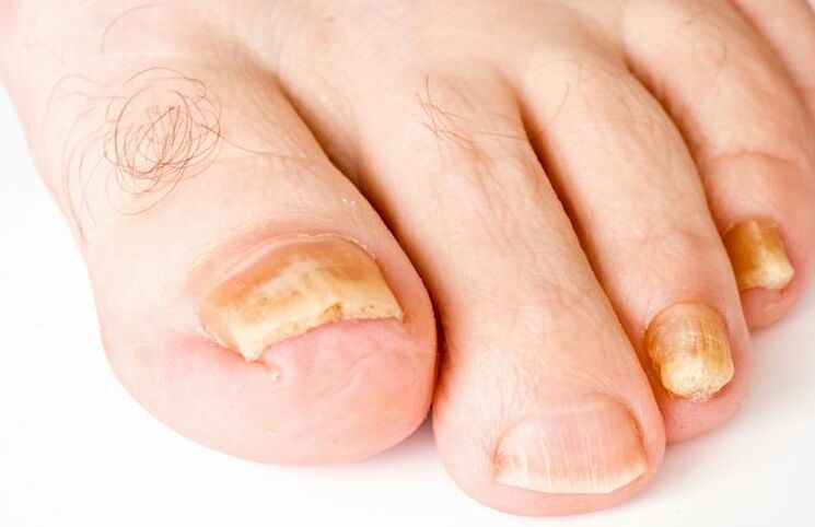 Yellow toenails are caused by fungus