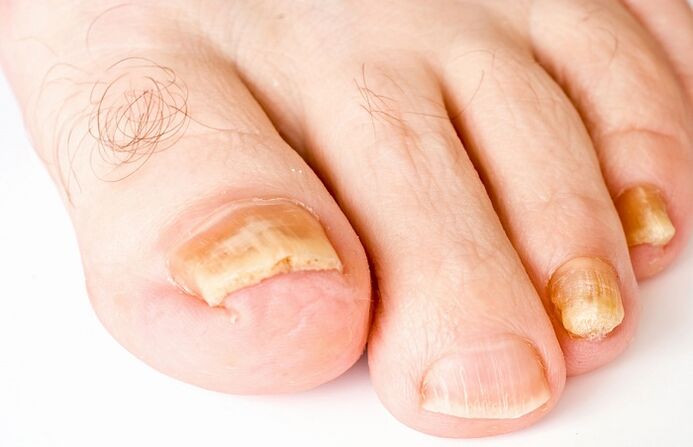 yellow nails due to fungal infection