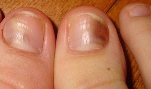 nail fungus