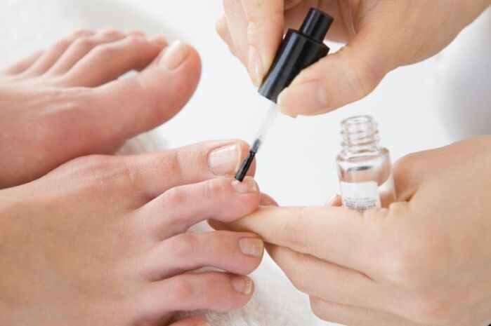 Regular use of medical varnish will speed up the treatment of onychomycosis