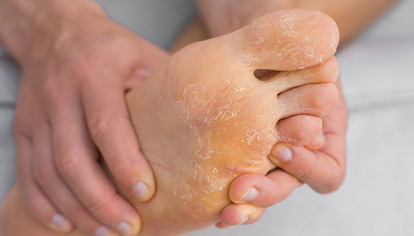 Flaky skin and itching are symptoms of athlete's foot