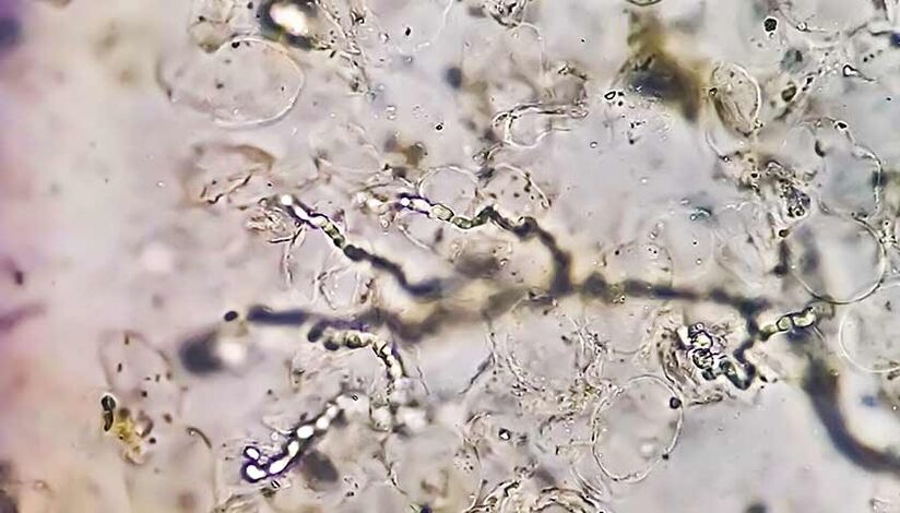 Fungi under the microscope - the cause of the development of foot mycosis