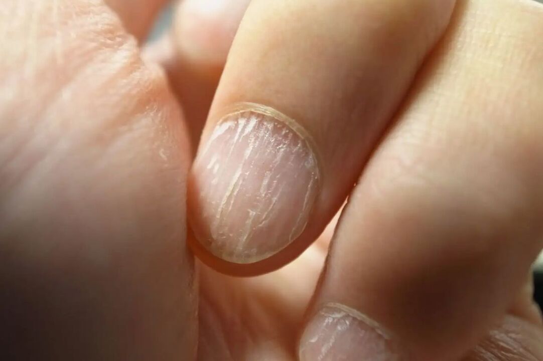 Hapalochnia on nails