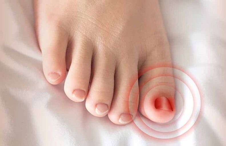 ingrown toenails