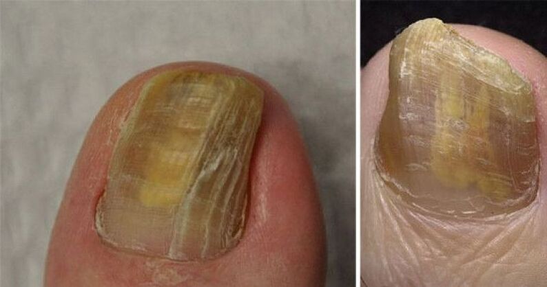 onychodystrophy of the nails